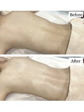 ルヴィカカリーナ(REVI Cacalena)/背中ケアコース