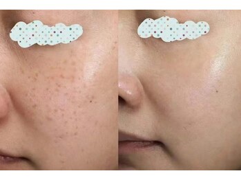 シャンディール(Shandeel)/小顔、シミ肌改善、ブライダルー