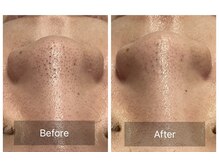 アヴニール 光の森(AVENIR)/毛穴洗浄☆3回の効果