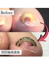 巻き爪矯正