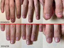 エルシャイン(L-shine)/深爪矯正