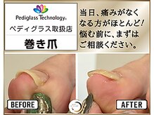 サロン エクラ(salon ECLAT)の雰囲気(巻き爪は早めのケアで改善がスムーズに!1度目から効果実感◎)