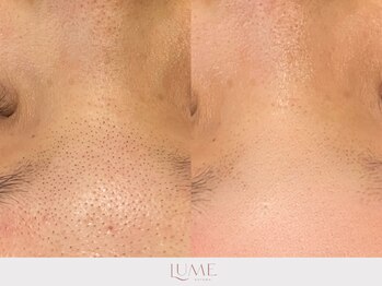 ルーミー 南青山(LUME)/フェイシャルワックス脱毛