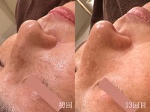 ウォーム(warm)/シミケア/美白/脱ピーリング