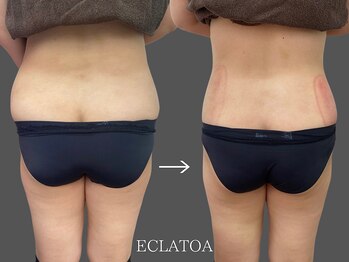 【次世代脂肪冷却・小顔ハイリフト専門店】ECLATOA　四日市/痩身/ダイエットの写真/【短期集中】無駄なく最短で理想の姿へ！四日市の次世代・脂肪冷却×キャビ×EMSで確実なサイズダウン実感