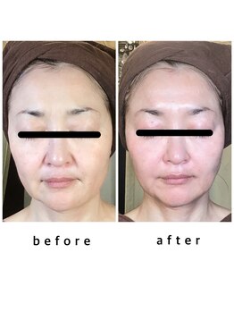 エクレボーテ(ECOULERBEAUTE)/施術例:ハーブピーリング