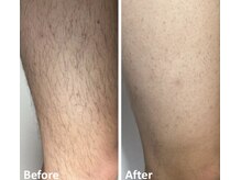 グレイス(Grace)/メンズひざ上脱毛