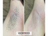 新規様限定！【レディース】両脇・ＷＡＸ+光脱毛　ダブル脱毛で即ツルスベ♪
