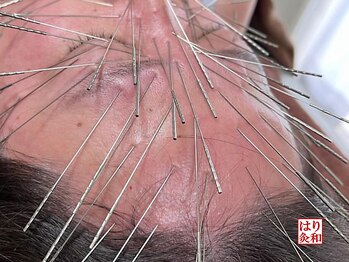 はりきゅう和 ルート鍼灸院/疲れ目