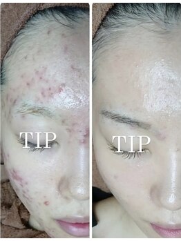 晴(haru)/ハーブピーリング