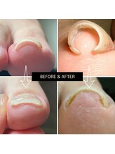 まき爪晴れる/気になっても放置していた爪