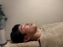 【美容鍼灸】鍼灸で自己治癒力・仕事の効率を高める。