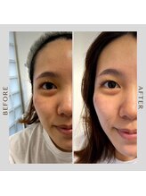 ケトリーナ/毛穴ケア/ピーリング/30代女性