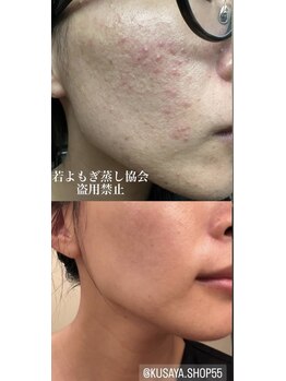 スイ(Sui)/【若よもぎ蒸し】Before/After