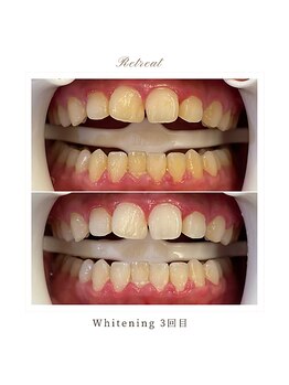 リトリート(Retreat)/ホワイトニング【3回ご来店】