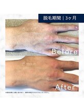 メンズクリア 上水戸ドンキ店/【メンズクリア】お客様の施術例