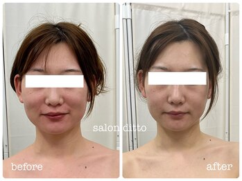 サロンディト(ditto)/【施術1回】小顔コルギ+肩甲骨