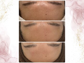 ウェリナポノビューティサロン(welina pono beauty salon)/《小顔/毛穴/脱毛》