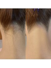 キアラ 麻布十番(Kiara)/うなじ脱毛のビフォーアフター