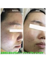 モカ 天王寺店(MOKA)/ホホニキビケアハーブピーリング