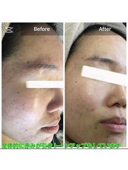 モカ 天王寺店(MOKA)/ホホニキビケアハーブピーリング