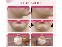 ココ センガ ビューティー クリニック(COCO SENGA Beauty-Clinic)/脂肪分解JET☆効果写真☆