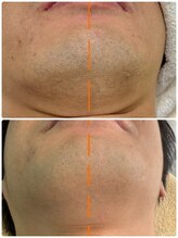 プルメリスタ 八千代緑が丘店/ヒゲ脱毛(２回照射から２週間後)