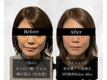 アロエ鍼灸整体院/美容鍼×小顔矯正|4回施術
