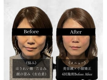アロエ鍼灸整体院/美容鍼×小顔矯正|4回施術