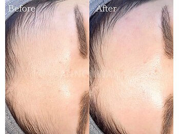 ポアラ(POARA)/毛穴/ワックス脱毛