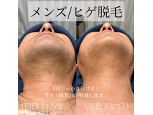 カナウ(KANAU)の雰囲気(ヒゲ脱毛は、まずは5回しっかり受けて効果を実感してください◎)