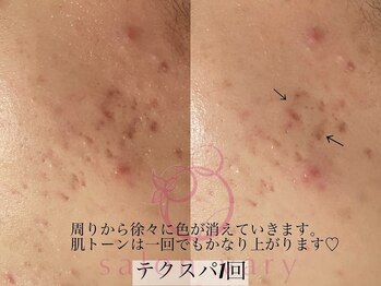 サロンヴェアリー 広尾(salon vary)/水玉リフティングテクスパ1回
