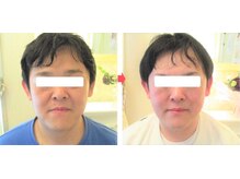 サロンドエステケイワイ(de KY)/フェイシャル☆小顔・タルミ改善