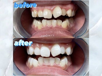 ライトケアサロン 銀座店(Light Care Salon)/セルフホワイトニングの症例写真