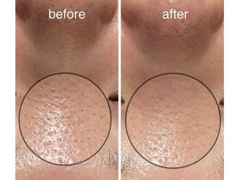 ビーアンドビー(B&B)/ハイドロコース