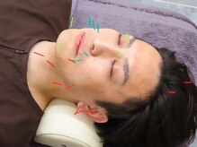 ハンドワーク(HANDWORK)/メンズ美容鍼