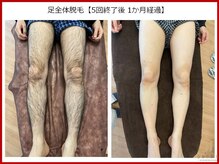ひかり素肌/足全体脱毛（前面）