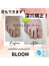 ブルームブルーム(BLOOMブルーム)/足もできます！深爪矯正