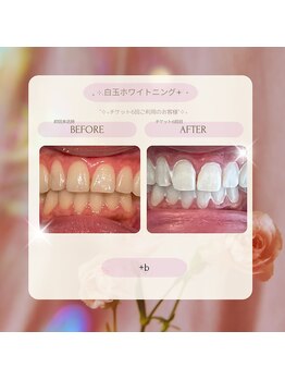 プラスビー 2号店(+b)/ホワイトニングビフォーアフター