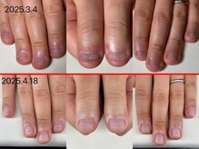 エルシャイン(L-shine)/深爪矯正