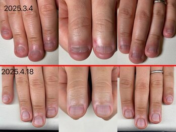 エルシャイン(L-shine)/深爪矯正