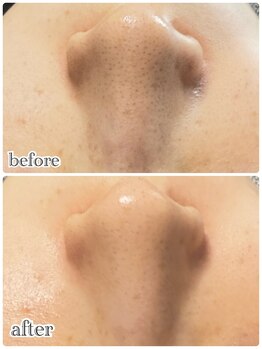 ニュイ(nuit)/ハイドロスプラッシュ毛穴洗浄