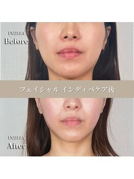 術後の女神 大阪本町店/ダウンタイムケア・インディバ