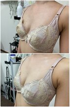 バーディー(BIRDIE)/施術３回/２０代/A→C左右差改善