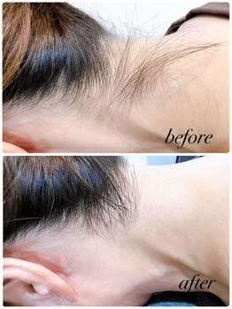 リノ レイ(Lino Ray)/うなじ脱毛