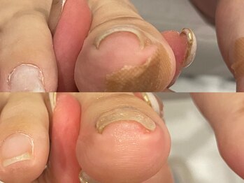 キラネイル アンド アイラッシュ by World Beauty(KIRA)/巻爪補正 ペディグラス