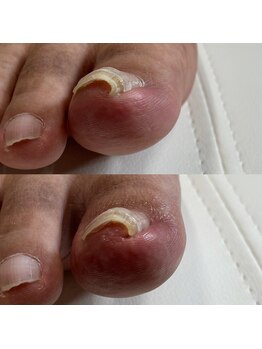 リリ(lili)/巻き爪矯正3回目(右親指)