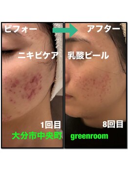 グリーンルーム(green room)/繰り返しニキビケア8回目