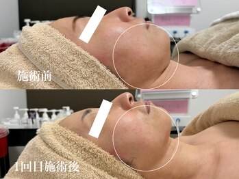 キーオブフェイス(Key of Face)/お悩み「お顔全体のたるみ」