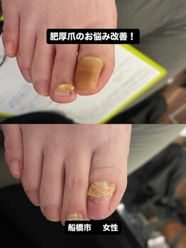 巻き爪じゅん 千葉駅前店/肥厚爪に悩む方必見！